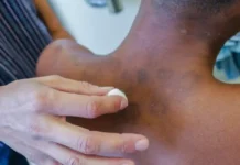 AGU lança plano nacional de negociação para indenizar segregados pela hanseníases